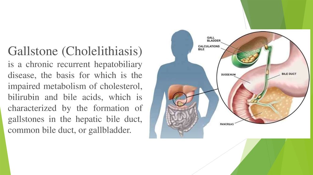Cholelithiasis (Gallstones)