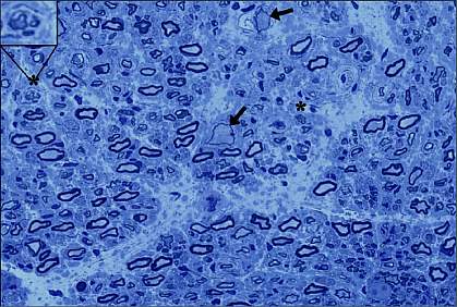 Indigo-stained sensory nerve biopsy viewed under a microscope.