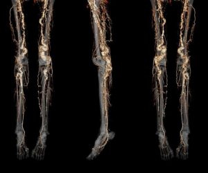 A CT angiography scan of a person with ACDC disease showing abnormal calcification of the blood vessels in the legs and feet.