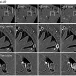 A series of MRI images showing the movement of light-emitting molecules moving through the arachnoid barrier.