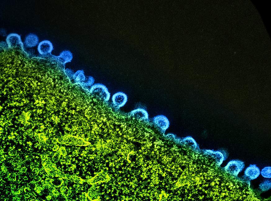 Colorized transmission electron micrograph of HIV-1 virus particles (blue) budding and replicating from an H9 T cell (bright green). The virus particles are in various stages of maturity, which accounts for differences in shape.