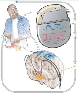 Drawing of a patient with a deep brain stimulation device as they prepare food in the kitchen